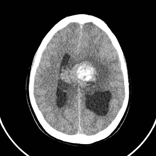 Central neurocytoma (Radiopaedia 84497-99871 Axial non-contrast 33).jpg