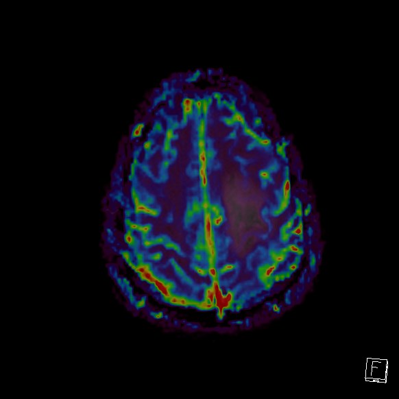 Central neurocytoma (Radiopaedia 84497-99872 Axial Perfusion 58).jpg