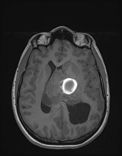 Central neurocytoma (Radiopaedia 84497-99872 Axial T1 114).jpg