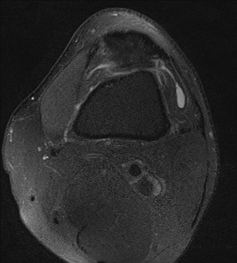 File:Central osteophyte (Radiopaedia 72592-83150 Axial PD fat sat 3).jpg