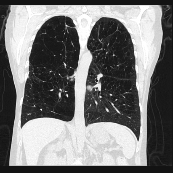 Centrilobular pulmonary emphysema (Radiopaedia 24495-24789 Coronal lung window 46).jpg