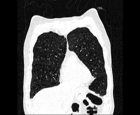 Centrilobular pulmonary emphysema (Radiopaedia 62468-70718 Coronal lung window 16).jpg