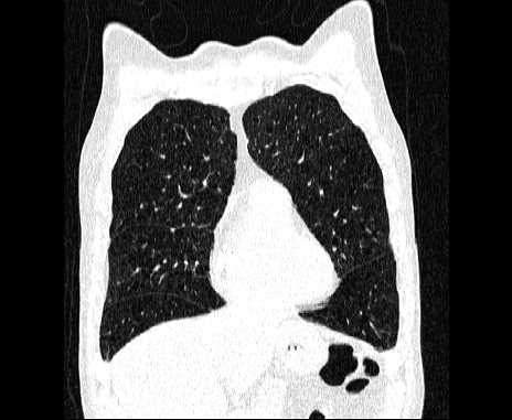 Centrilobular pulmonary emphysema (Radiopaedia 62468-70718 Coronal lung window 19).jpg