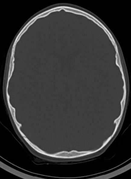 Cerebellar abscess (Radiopaedia 73727-84527 Axial bone window 37).jpg
