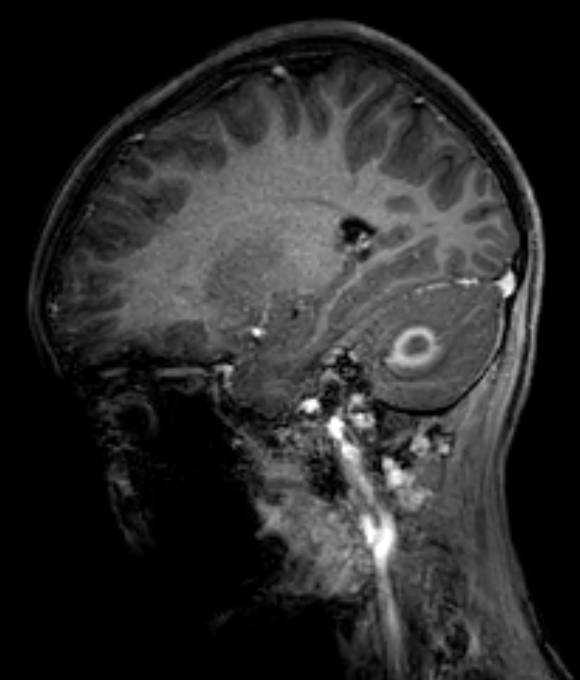 Cerebellar abscess (Radiopaedia 73727-84563 J 44).jpg