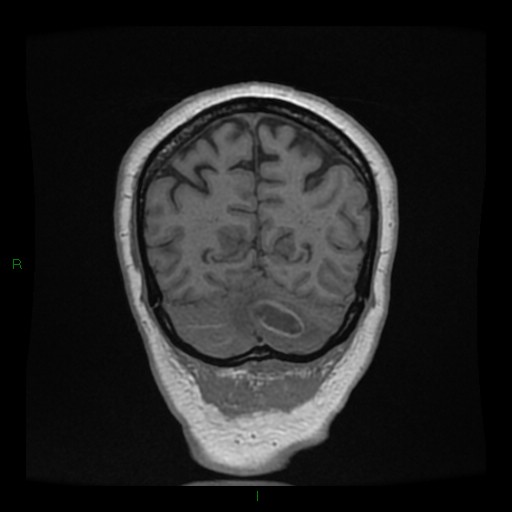 Cerebellar abscess (Radiopaedia 78135-90678 Coronal T1 C+ 134).jpg