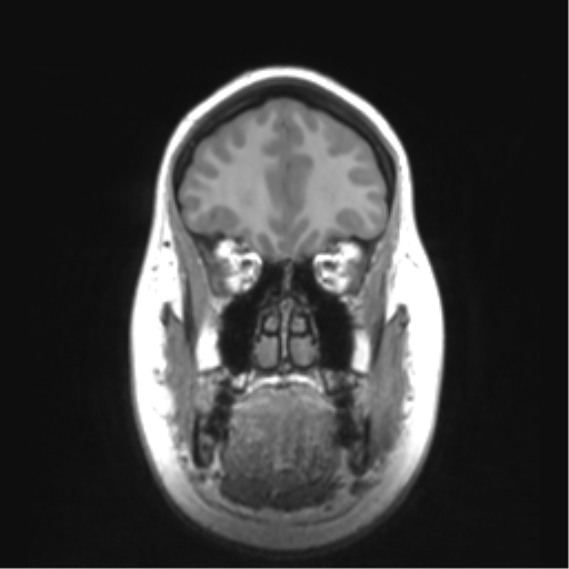 Cerebellar ependymoma complicated by post-operative subdural hematoma (Radiopaedia 83322-97736 Coronal T1 13).png