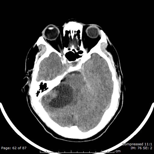 Cerebellar hemangioblastoma (Radiopaedia 52360-58258 Axial non-contrast 62).jpg