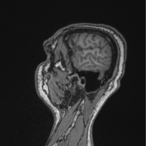 Cerebellar hemangioblastomas and pituitary adenoma (Radiopaedia 85490-101176 Sagittal T1 26).png
