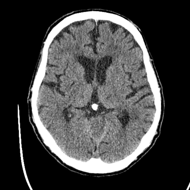 Cerebellar hemorrhage (Radiopaedia 27193-27359 Axial non-contrast 25).jpg