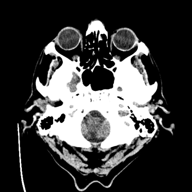 Cerebellar hemorrhage (Radiopaedia 27193-27359 Axial non-contrast 3).jpg