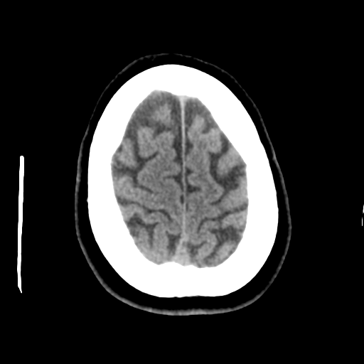 Cerebellar metastasis (cystic appearance) (Radiopaedia 41395-44258 Axial non-contrast 46).png