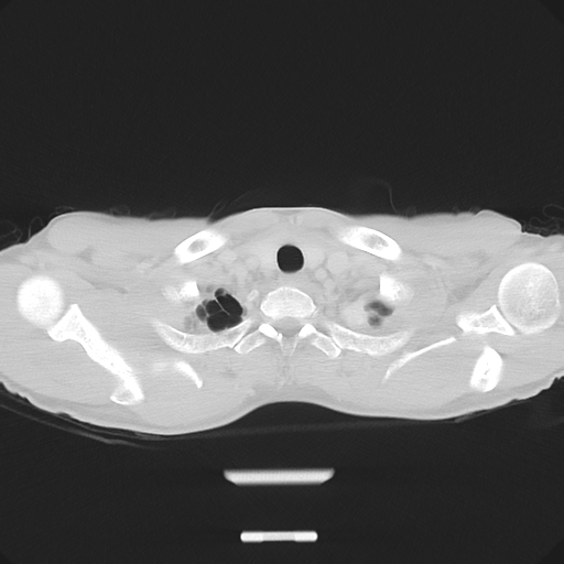 Cerebellar metastasis - adenocarcinoma lung (Radiopaedia 63184-71717 Axial lung window 8).png