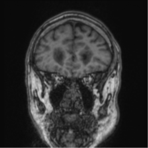 Cerebellar metastasis from lung adenocarcinoma (Radiopaedia 86690-102829 Coronal T1 76).png