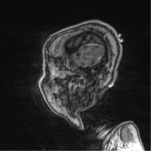 Cerebellar metastasis from lung adenocarcinoma (Radiopaedia 86690-102829 Sagittal T1 C+ 73).png
