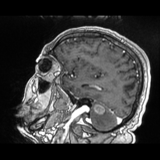 Cerebellar metastasis of pulmonary adenocarcinoma, cavernous venous malformation, and developmental venous anomaly (Radiopaedia 85827-101661 Sagittal T1 C+ 31).jpg