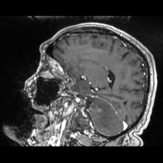 Cerebellar metastasis of pulmonary adenocarcinoma, cavernous venous malformation, and developmental venous anomaly (Radiopaedia 85827-101661 Sagittal T1 C+ 39).jpg