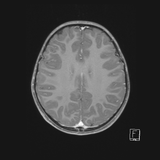 File:Cerebellar stroke (Radiopaedia 32202-33150 Axial T1 C+ 48).png