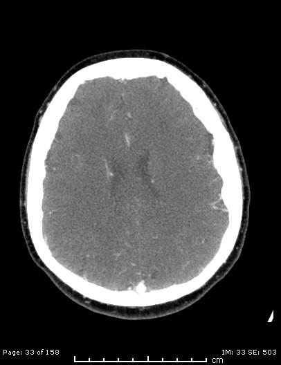 Cerebellar strokes due to intracranial giant cell arteritis (Radiopaedia 68799-78510 CT angiogram 33).jpg