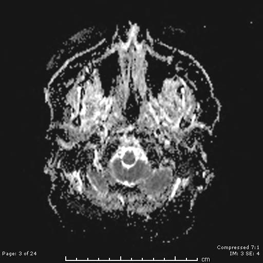 File:Cerebellar strokes due to intracranial giant cell arteritis (Radiopaedia 68799-81713 Axial ADC 3).jpg