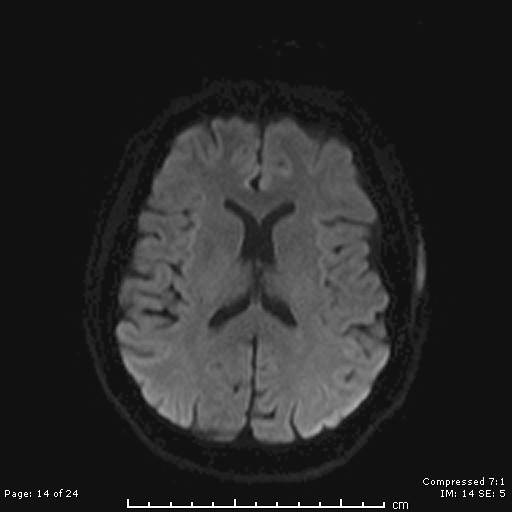 File:Cerebellar strokes due to intracranial giant cell arteritis (Radiopaedia 68799-81713 Axial DWI 14).jpg
