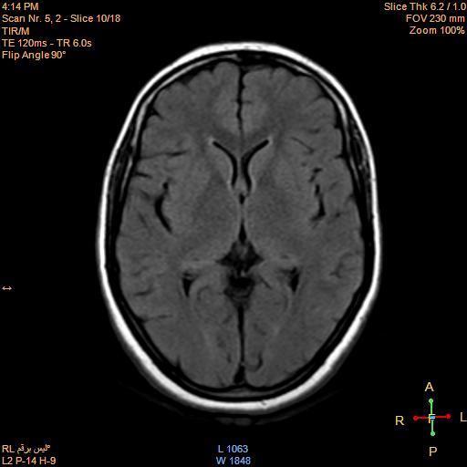 File:Cerebellopontine angle meningioma (Radiopaedia 22488-22525 Axial FLAIR 9).jpg