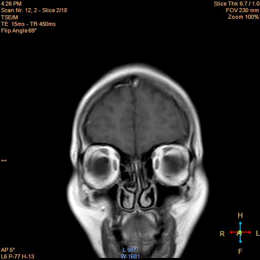 File:Cerebellopontine angle meningioma (Radiopaedia 22488-22525 Coronal T1 C+ 2).jpg