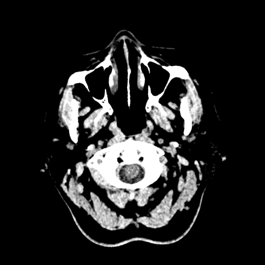 Cerebellopontine angle meningioma (Radiopaedia 53561-59592 Axial non-contrast 1).jpg