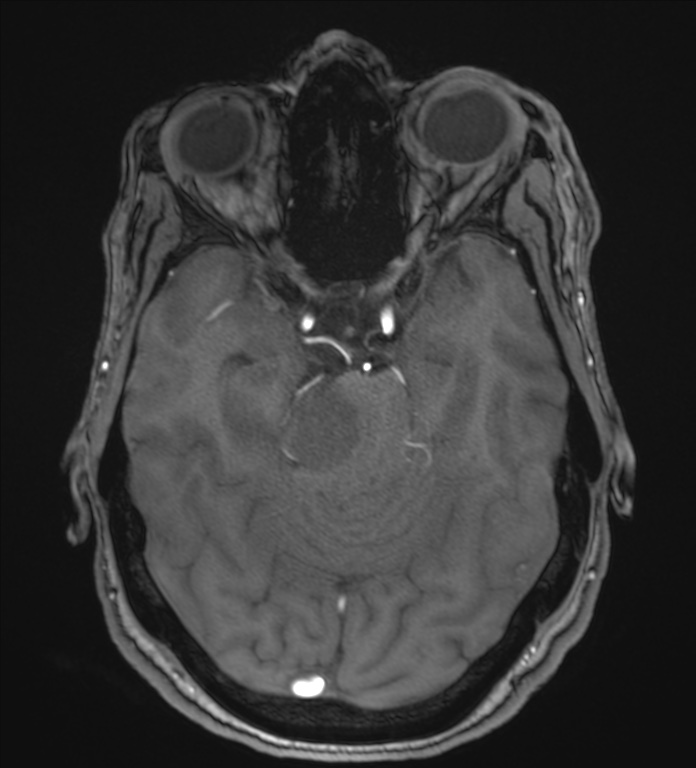 Cerebellopontine angle meningioma (Radiopaedia 72983-83680 Axial MRA 43).jpg