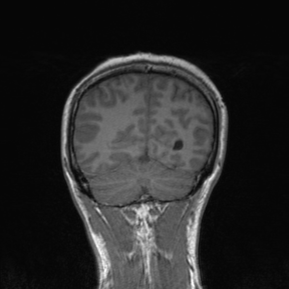 Cerebral abscess (Radiopaedia 24212-24478 Coronal T1 161).jpg
