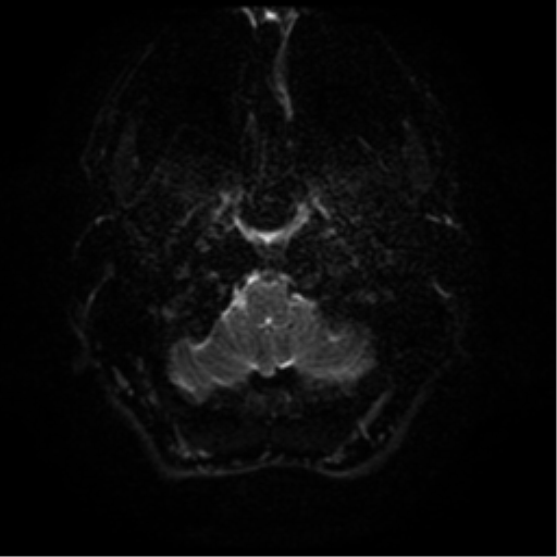 File:Cerebral abscess (Radiopaedia 57774-64740 Axial DWI 31).png