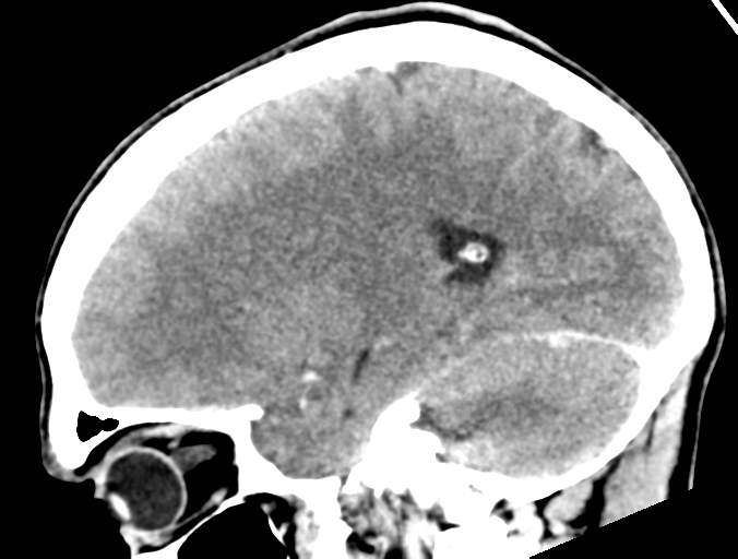 Cerebral abscess (Radiopaedia 60342-68008 Sagittal C+ delayed 18).png