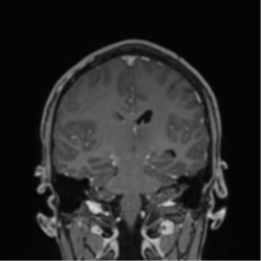 File:Cerebral abscess (Radiopaedia 60342-68009 H 20).png