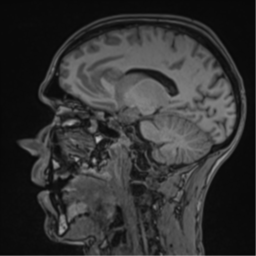 Cerebral abscess (Radiopaedia 60342-68009 Sagittal T1 25).png