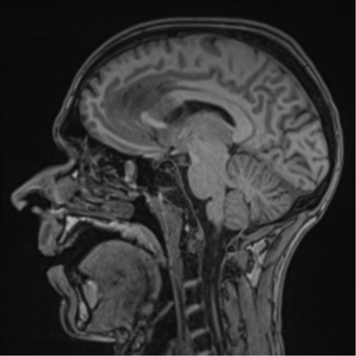 Cerebral abscess (Radiopaedia 60342-68009 Sagittal T1 27).png