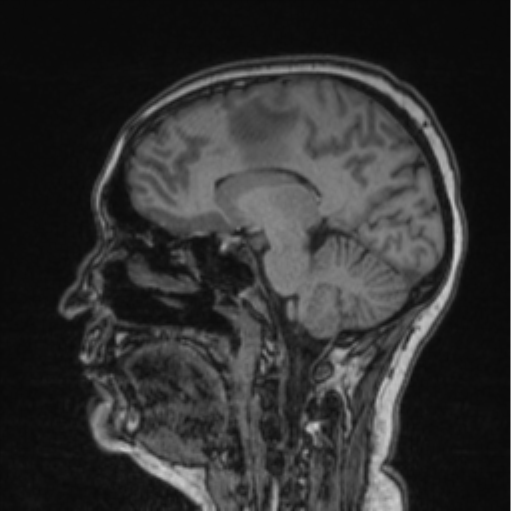 Cerebral abscess from pulmonary arteriovenous malformation (Radiopaedia 86275-102291 Sagittal T1 57).png
