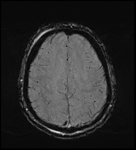 Cerebral abscess with ventriculitis (Radiopaedia 78965-91878 Axial SWI 40).jpg