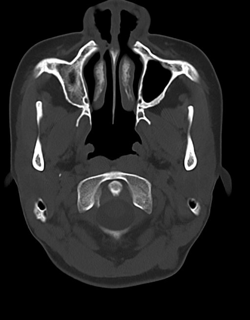 Cerebral abscesses (Radiopaedia 70458-80568 Axial bone window 9).jpg