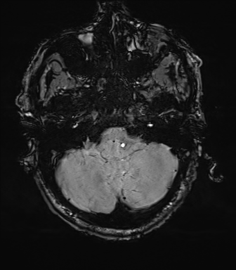 File:Cerebral amyloid angiopathy (Radiopaedia 46082-50433 Axial SWI 15).png