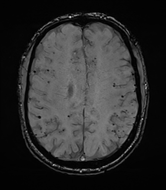Cerebral amyloid angiopathy (Radiopaedia 46082-50433 Axial SWI 56).png