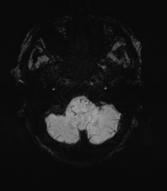 File:Cerebral amyloid angiopathy (Radiopaedia 46082-50433 Axial SWI MIP 9).png
