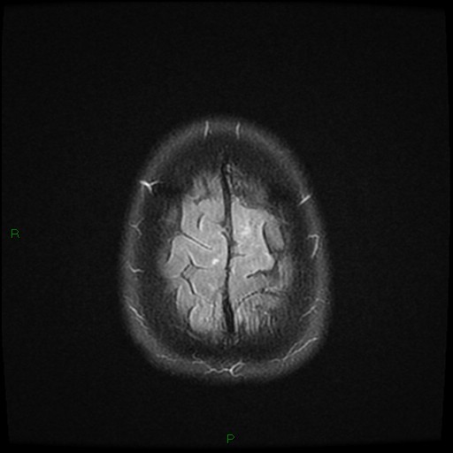 File:Cerebral amyloid angiopathy (Radiopaedia 77506-89664 Axial FLAIR 26).jpg