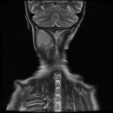 File:Cerebral and spinal tuberculosis (Radiopaedia 90489-107838 Coronal 3).jpg