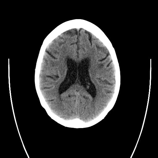 File:Cerebral aneurysm with rupture (Radiopaedia 29933-30457 B 1).jpg