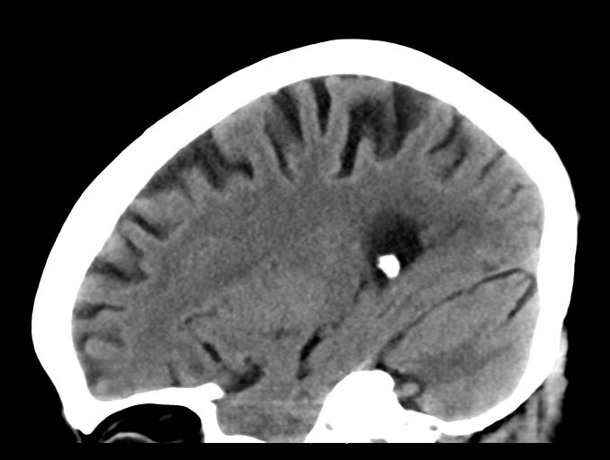 File:Cerebral aneurysm with rupture (Radiopaedia 29933-30457 B 21).jpg