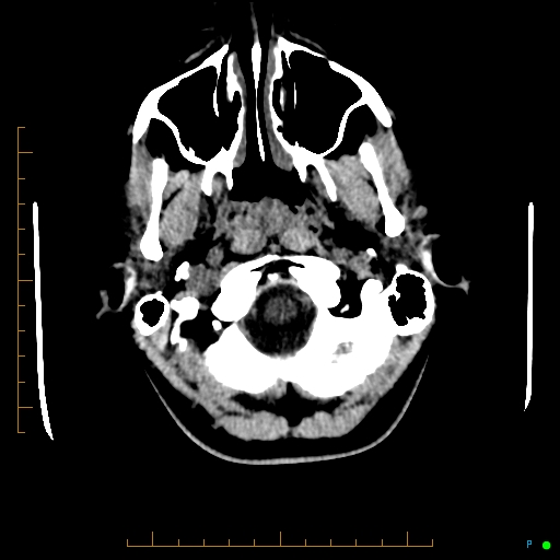 Cerebral arteriovenous malformation (AVM) (Radiopaedia 78162-90706 Axial non-contrast 8).jpg