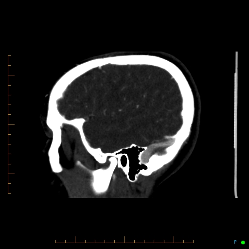 Cerebral arteriovenous malformation (AVM) (Radiopaedia 78162-90706 Sagittal CTA 64).jpg