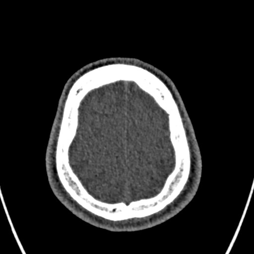 File:Cerebral arteriovenous malformation (Radiopaedia 78188-90746 Axial non-contrast 157).jpg