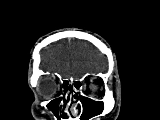Cerebral arteriovenous malformation (Radiopaedia 78188-90746 Coronal C+ delayed 11).jpg