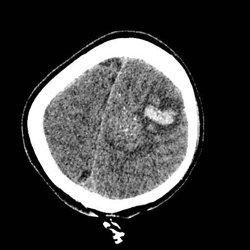 Cerebral arteriovenous malformation (Radiopaedia 79677-92887 Axial non-contrast 41).jpg